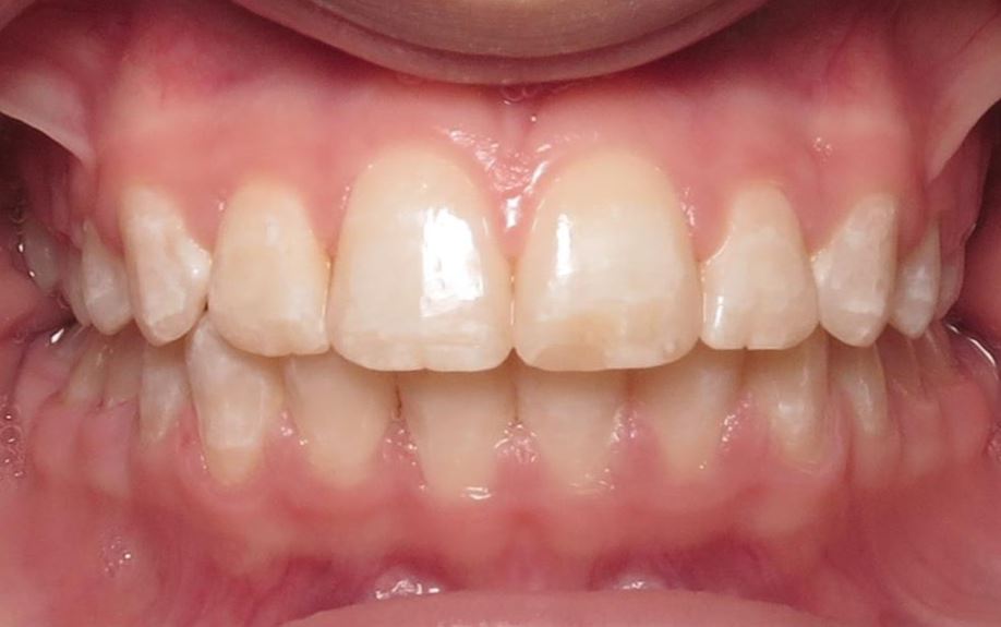 More smile transformations 81 Jfo smile gallery nora center final