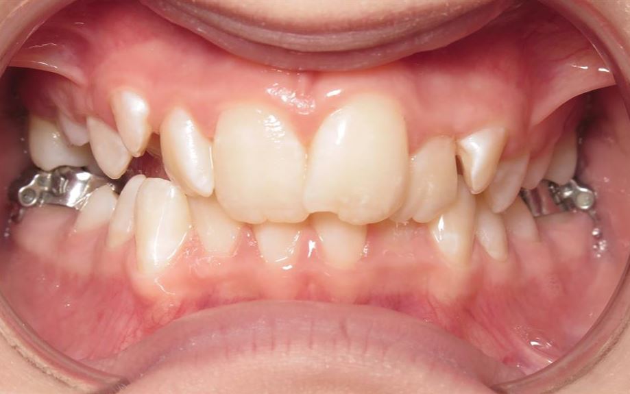 More smile transformations 80 Jfo smile gallery nora center start