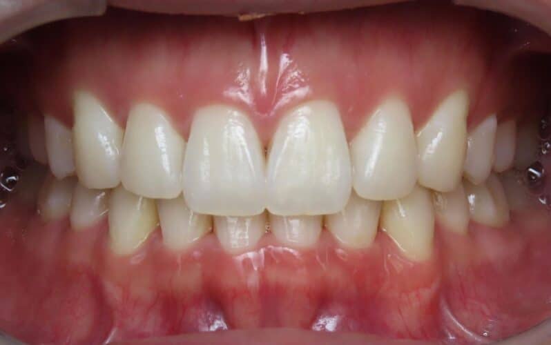 More smile transformations 87 Jfo smile gallery samy center final