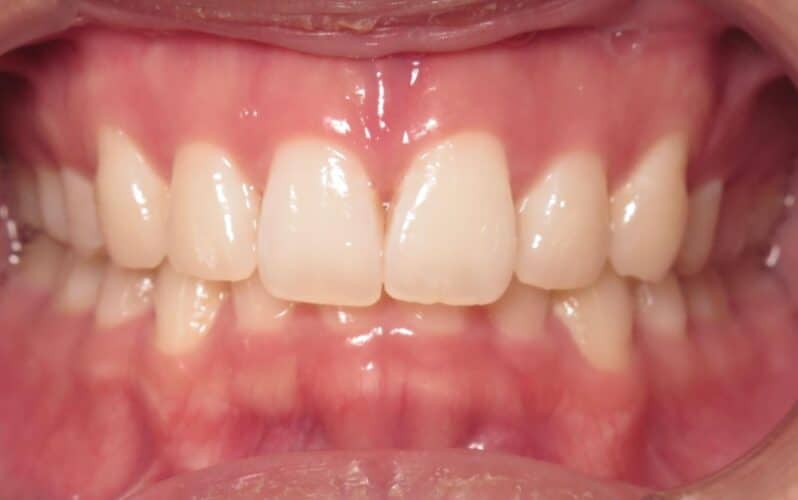 More smile transformations 86 Jfo smile gallery samy center start