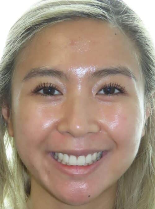 More smile transformations 85 Jfo smile gallery samy full face final