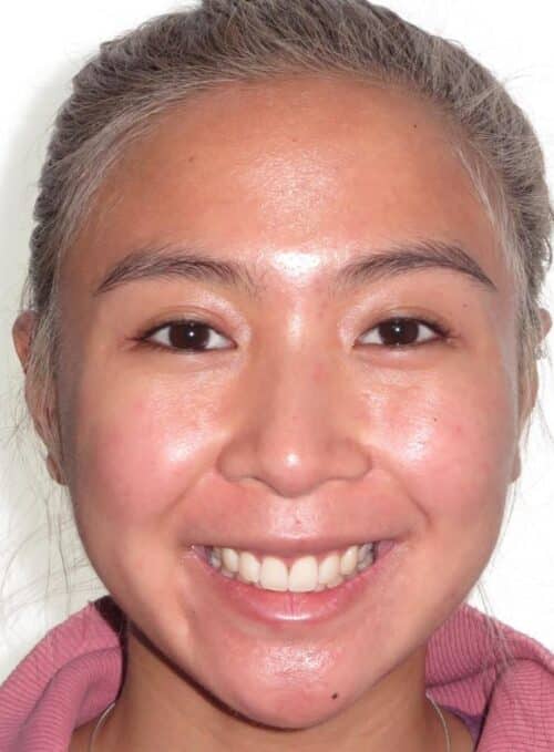 More smile transformations 84 Jfo smile gallery samy full face start