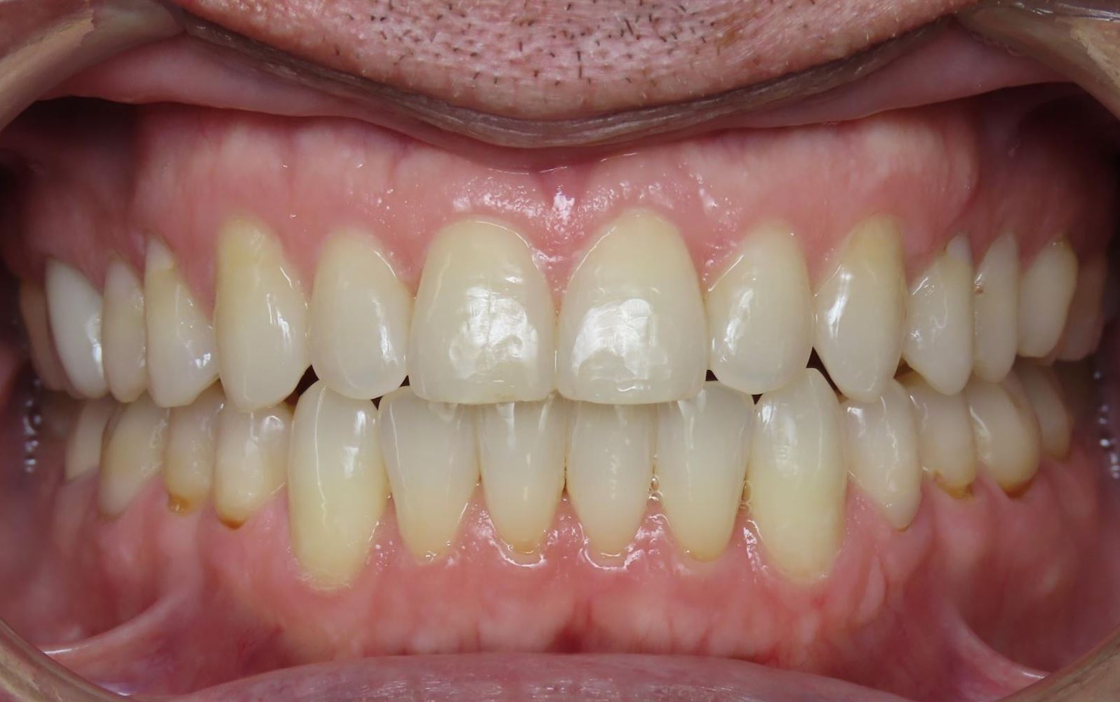 More smile transformations 89 Jfo smile gallery tim center final