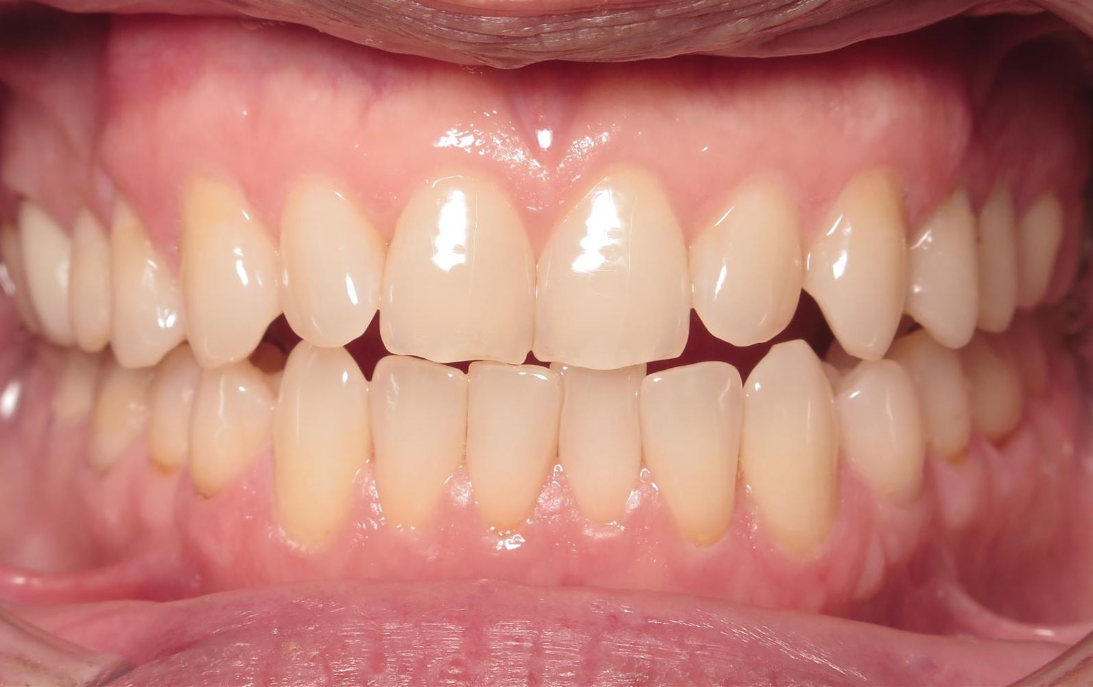 More smile transformations 88 Jfo smile gallery tim center start