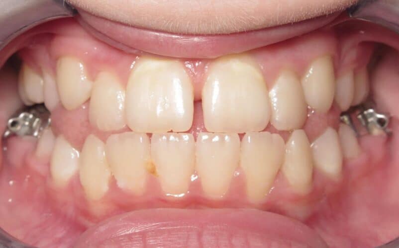 More smile transformations 76 Jfo smile gallery elissa center start
