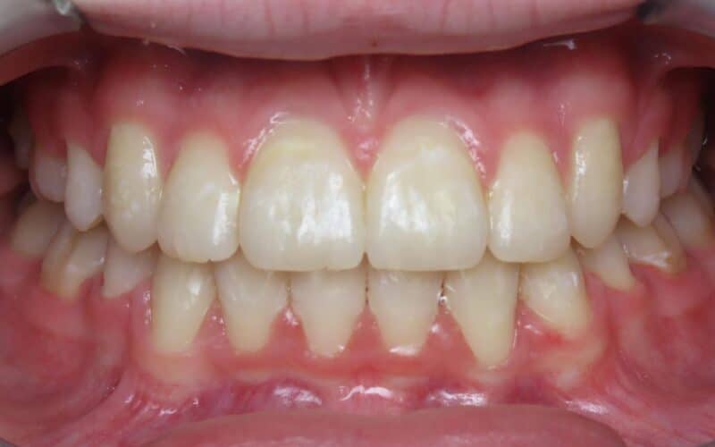 More smile transformations 77 Jfo smile gallery elissa center final