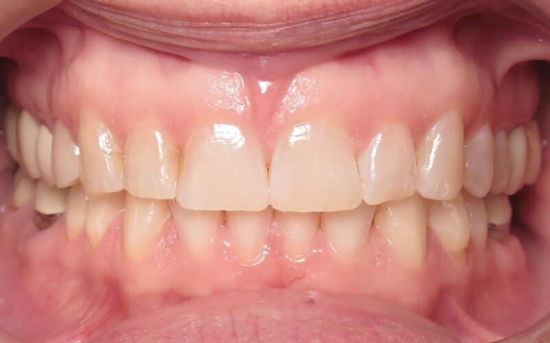 More smile transformations 79 Jfo smile gallery heather center final