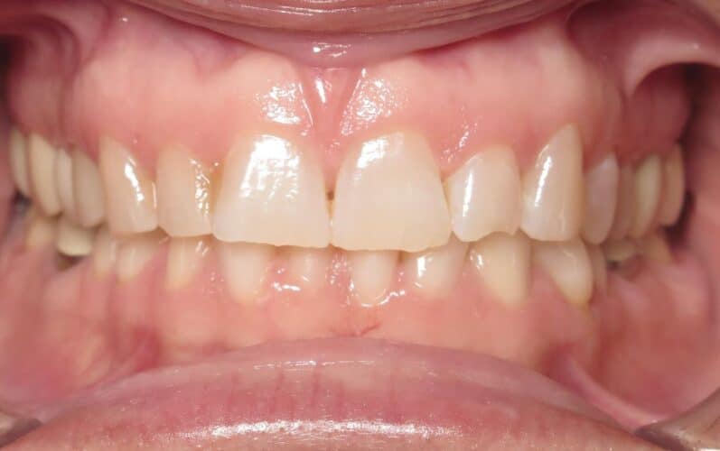 More smile transformations 78 Jfo smile gallery heather center start