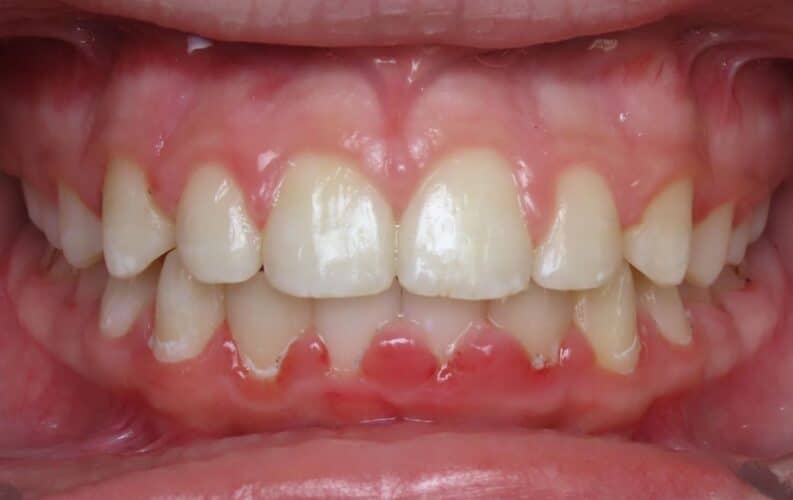 More smile transformations 73 Jfo smile gallery kylie center final