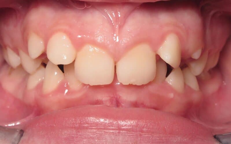 More smile transformations 72 Jfo smile gallery kylie center start