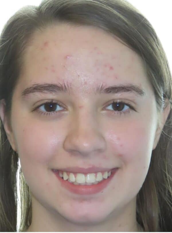 More smile transformations 71 Jfo smile gallery kylie full face final