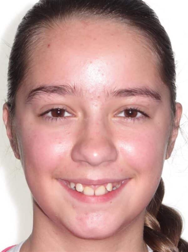 More smile transformations 70 Jfo smile gallery kylie full face start