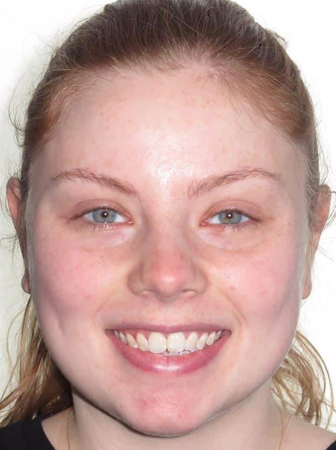 More smile transformations 68 Jfo smile gallery lauren full face start