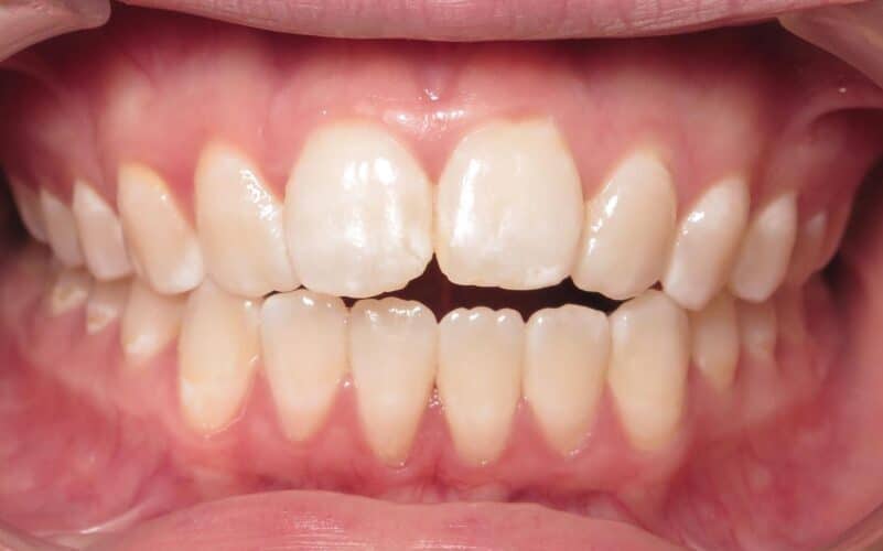 More smile transformations 66 Jfo smile gallery lauren center start