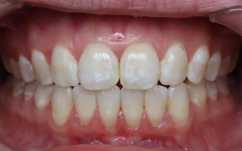 More smile transformations 67 Jfo smile gallery lauren center final
