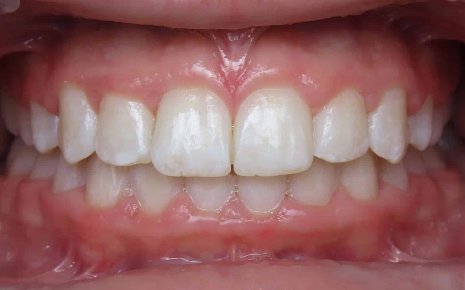 More smile transformations 65 Jfo smile gallery ava center final