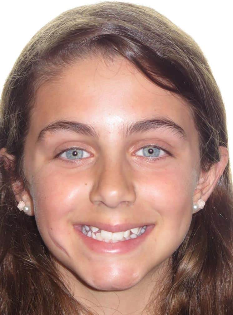 More smile transformations 62 Jfo smile gallery ava full face start