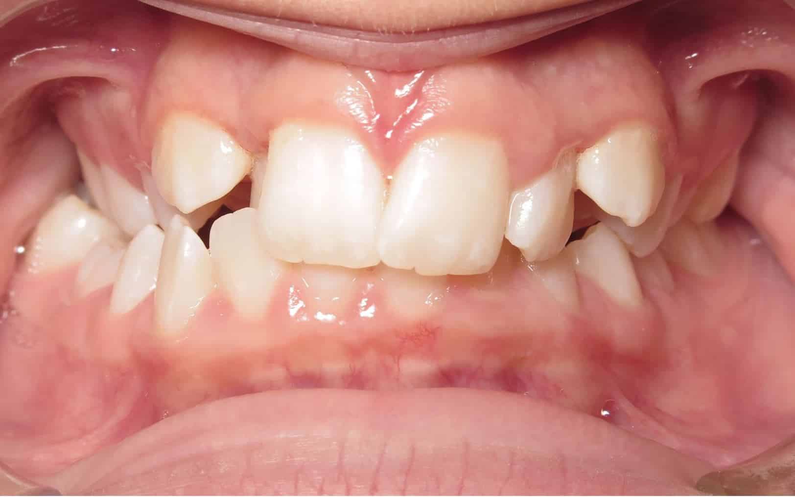 More smile transformations 64 Jfo smile gallery ava center start