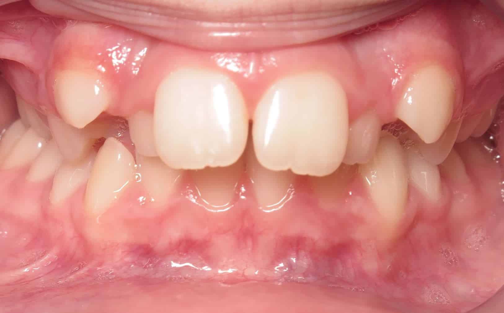 More smile transformations 58 Jfo smile gallery avery center start