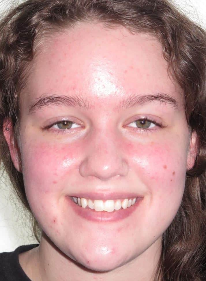 More smile transformations 52 Jfo smile gallery amaya full face start