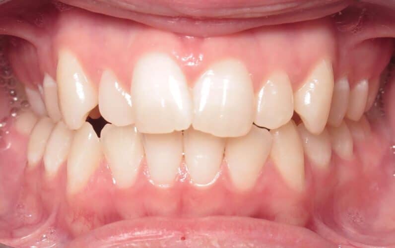 More smile transformations 50 Jfo smile gallery amaya center start