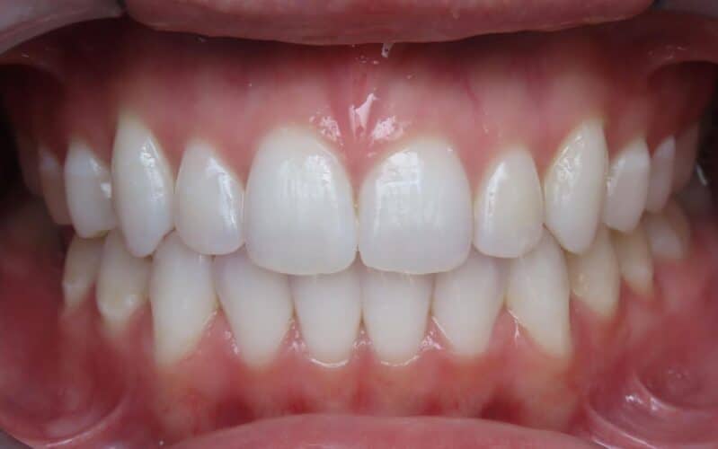 More smile transformations 51 Jfo smile gallery amaya center final