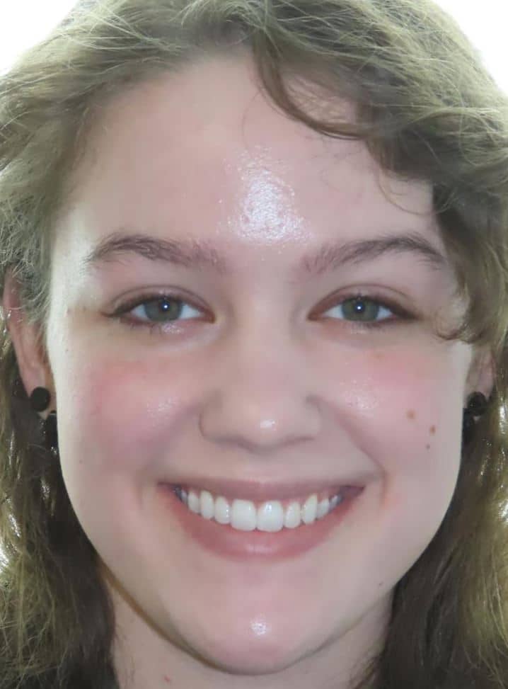 More smile transformations 53 Jfo smile gallery amaya full face final