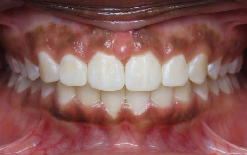More smile transformations 49 Jfo smile gallery jaleah center final