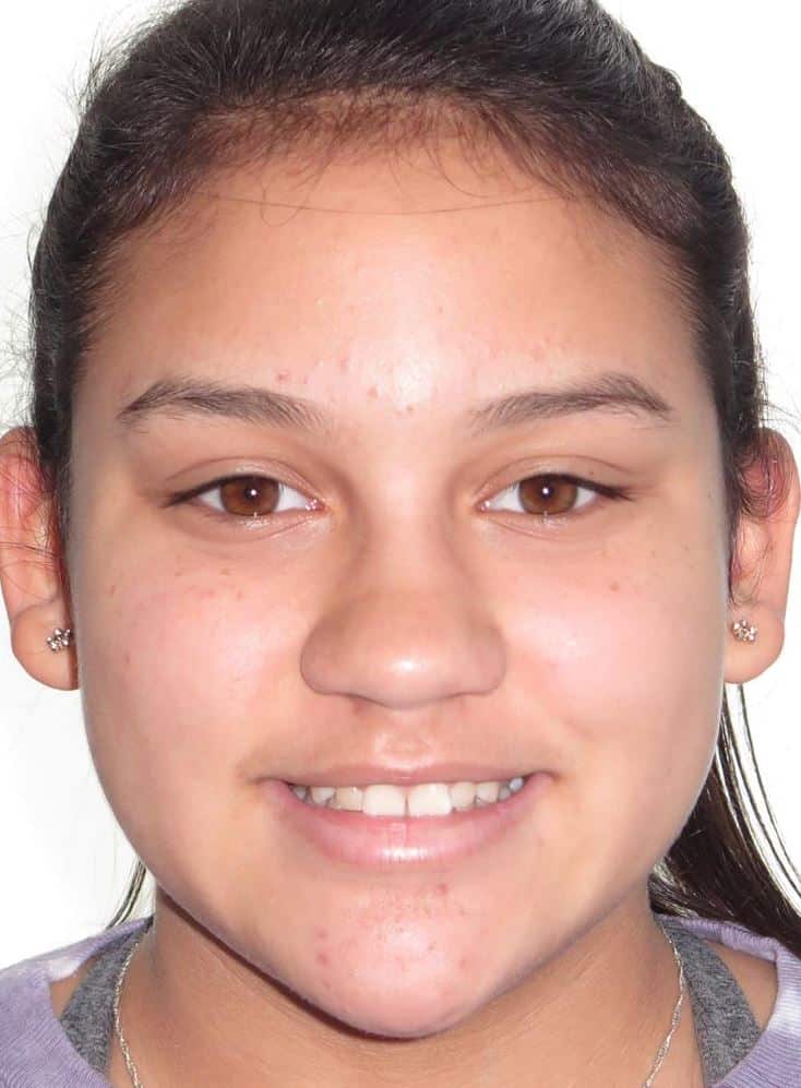 More smile transformations 54 Jfo smile gallery olivia full face start