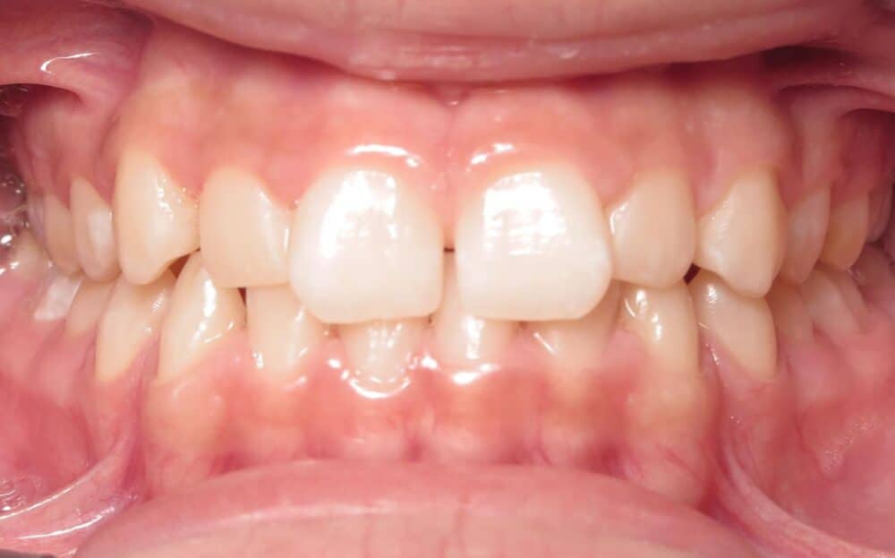 More smile transformations 56 Jfo smile gallery olivia center start