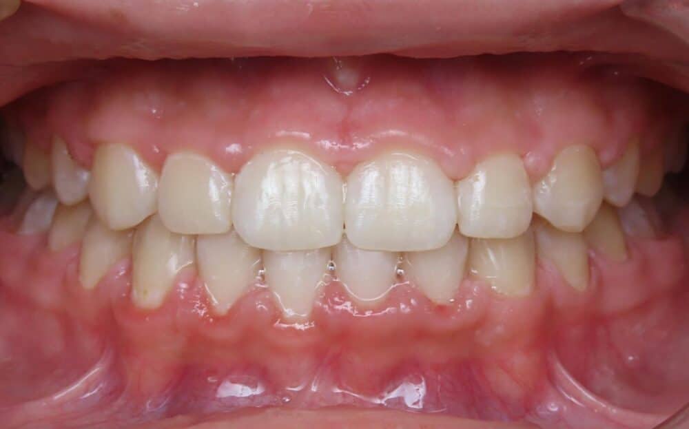 More smile transformations 57 Jfo smile gallery olivia center final