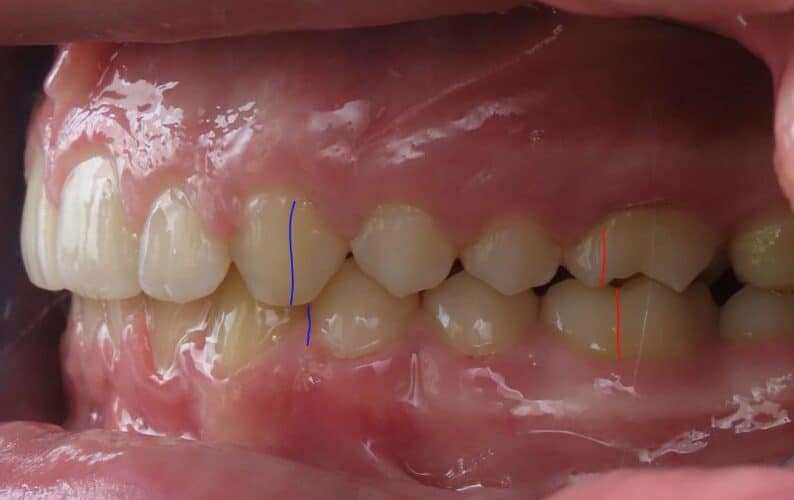 More smile transformations 35 Andrew buccal final