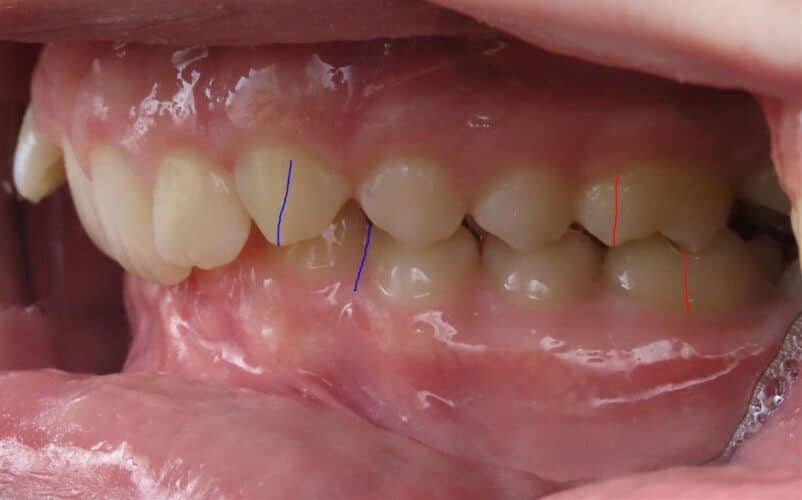 More smile transformations 34 Andrew buccal start