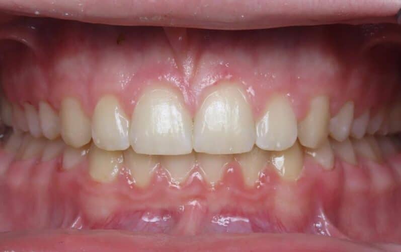 More smile transformations 33 Andrew center final