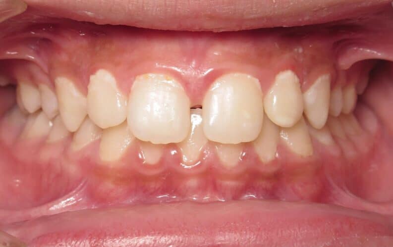 More smile transformations 40 Beni's beginning picture of smile