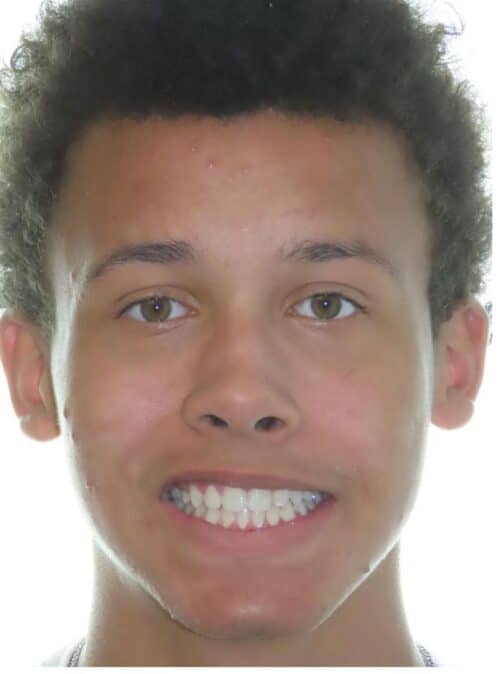 More smile transformations 39 Beni's final smile results