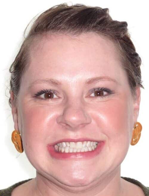 More smile transformations 28 Ellen smile start
