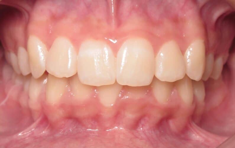 More smile transformations 42 Jfo smile gallery kylie center start