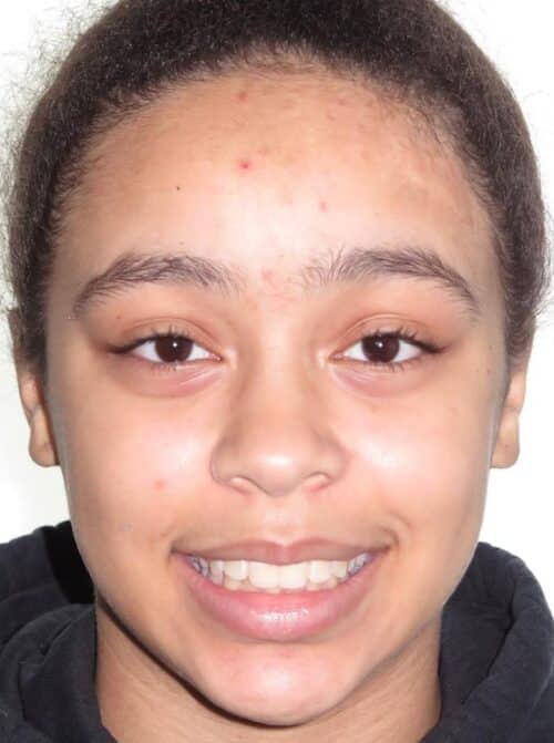 More smile transformations 44 Jfo smile gallery kylie full face start