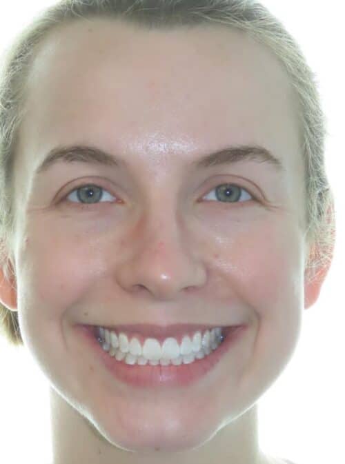 More smile transformations 27 Sela smile final