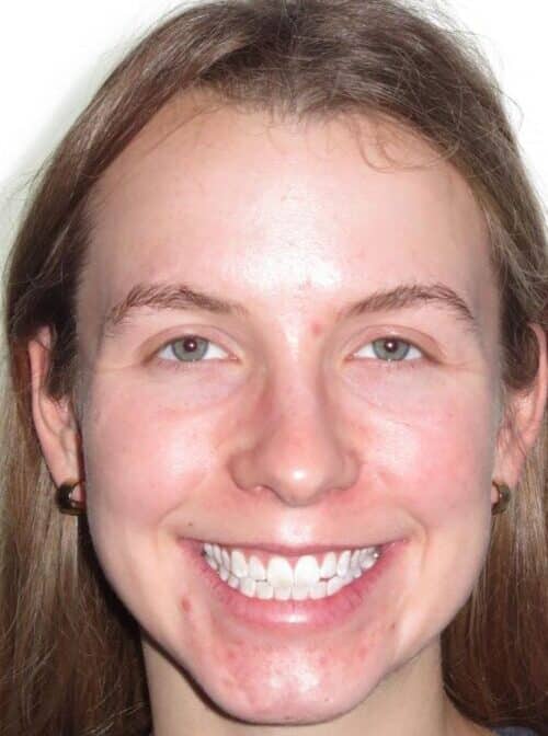More smile transformations 26 Sela smile start