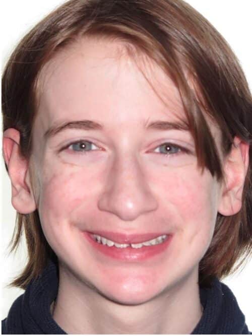 More smile transformations 20 Arlen smile start