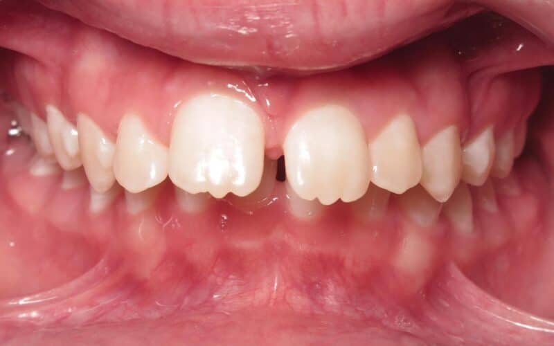 More smile transformations 22 Patient before image for orthodontic treatment