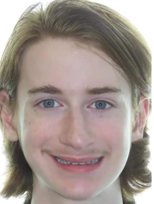 More smile transformations 21 Arlen smile final