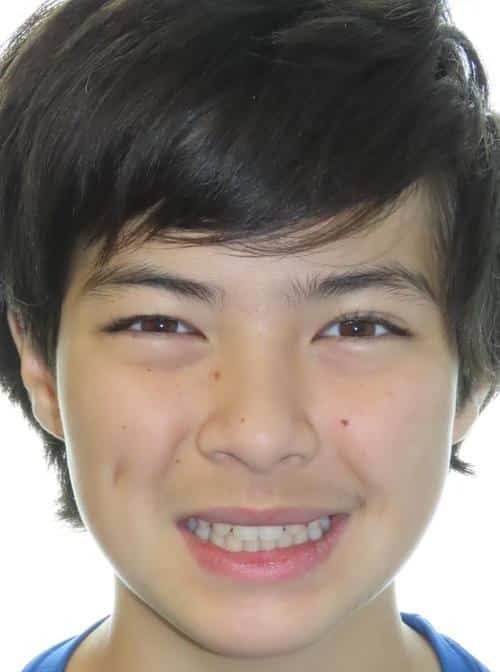 More smile transformations 15 Ben smile final