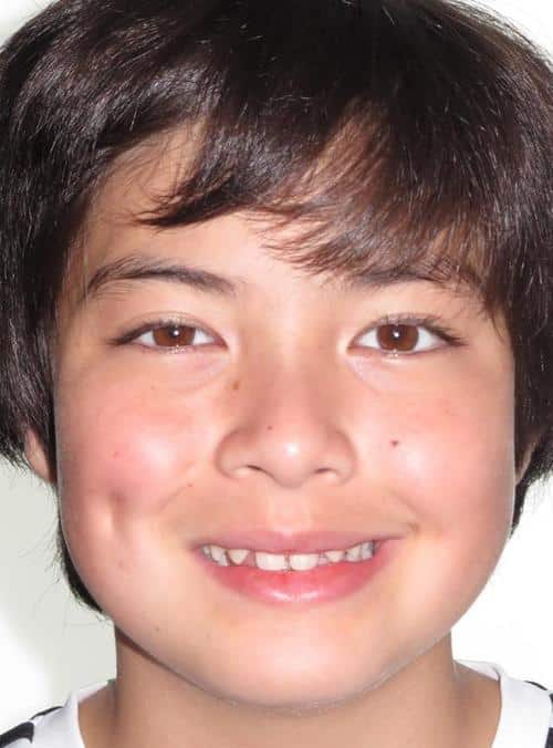 More smile transformations 14 Ben smile start
