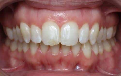 More smile transformations 17 Liz center final