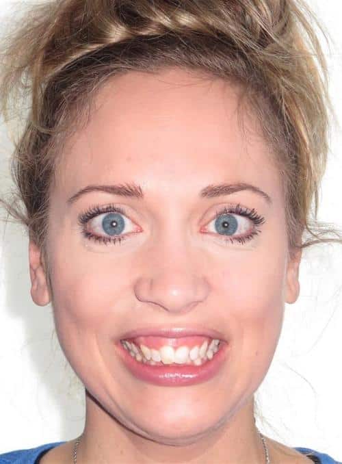 More smile transformations 18 Liz smile start