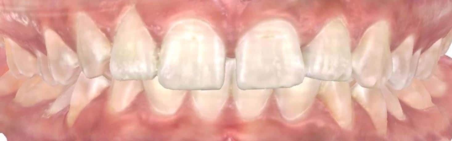 More smile transformations 10 Smile transformation before