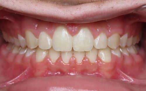 More smile transformations 9 Jfo smile gallery aidan center smile finish
